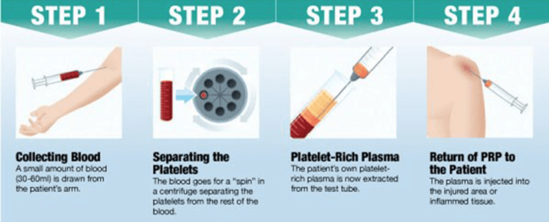 best-platelet-rich-plasma-therapy-prp-honolulu-hawaii