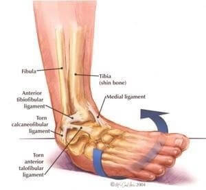 Ankle insability