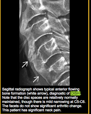 Dish (Diffuse Idiopathic Skeletal Hyperostosis) - Oahu Spine & Rehab