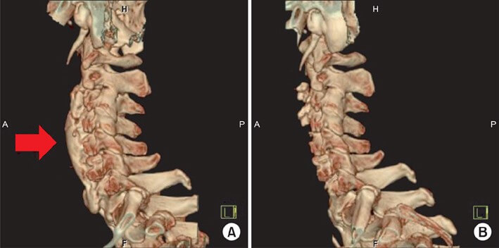 Dish (Diffuse Idiopathic Skeletal Hyperostosis)